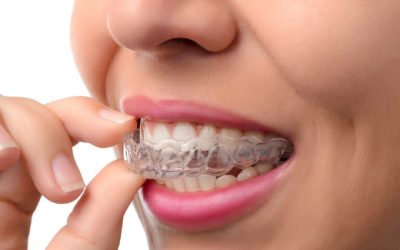 Ortodoncia Invisible: Transforma tu Sonrisa sin Sacrificar la Estética