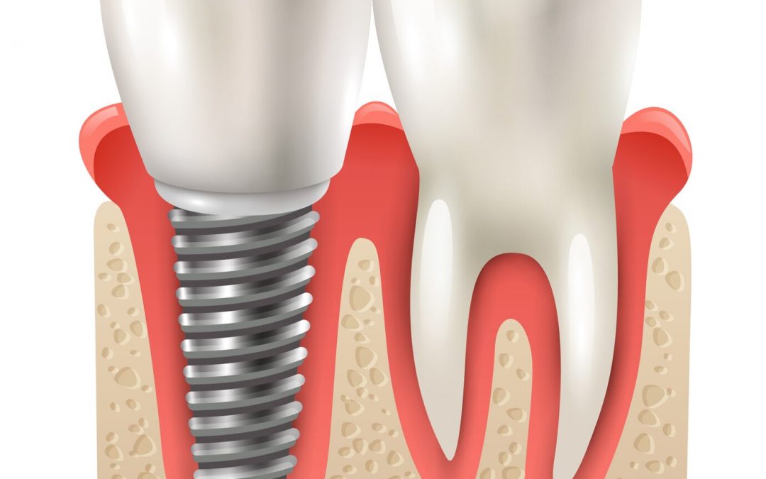 cirugía dental