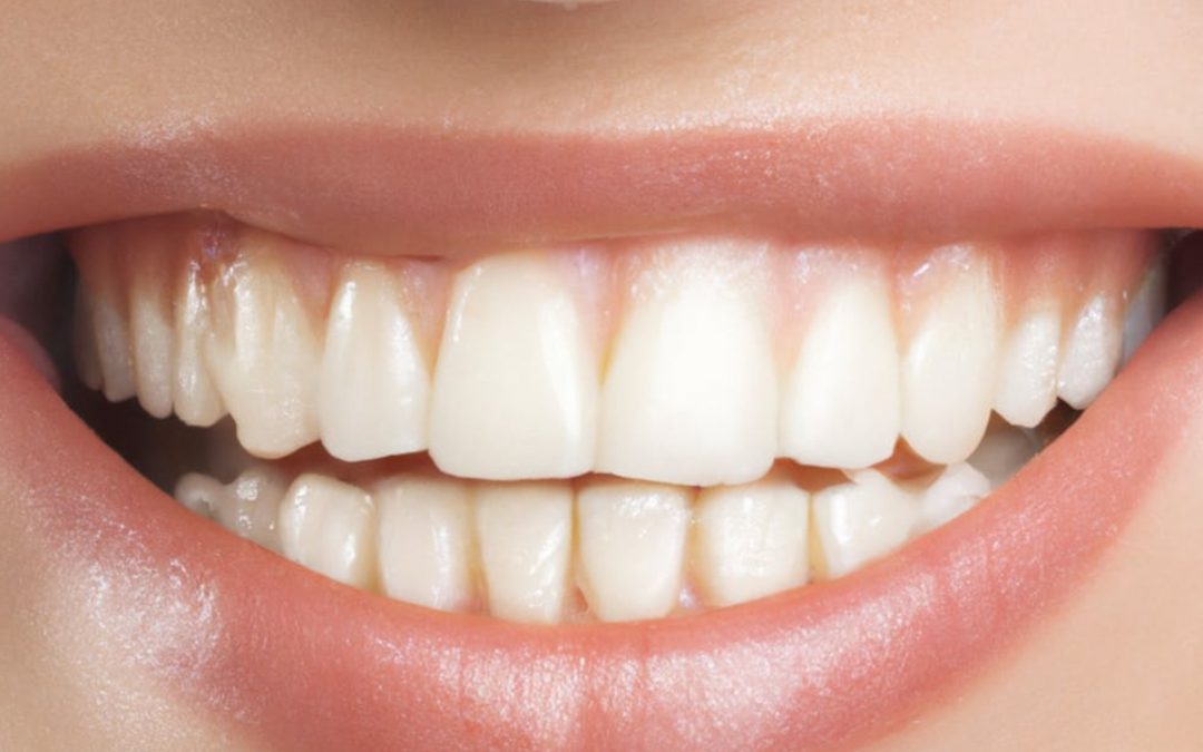 blanqueamiento dental